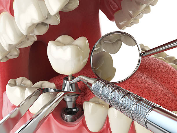 Best Urgent Tooth Repair  in Kensington, CA